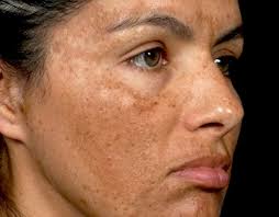 melasma.jpg